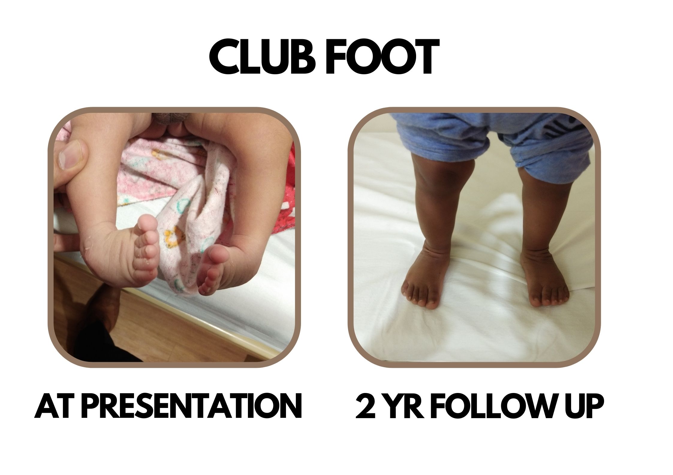 Club foot 
