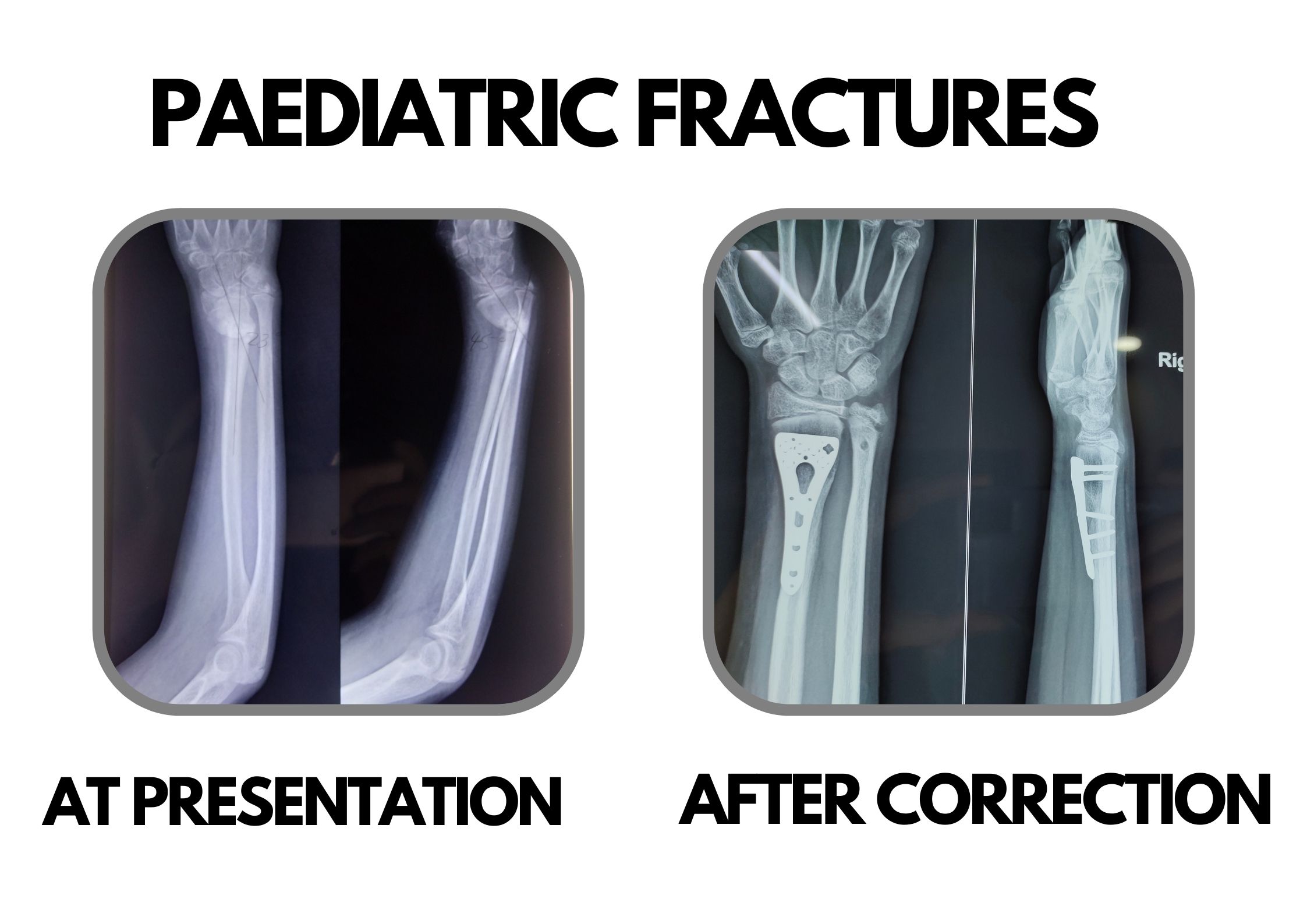 Paediatric Fractures