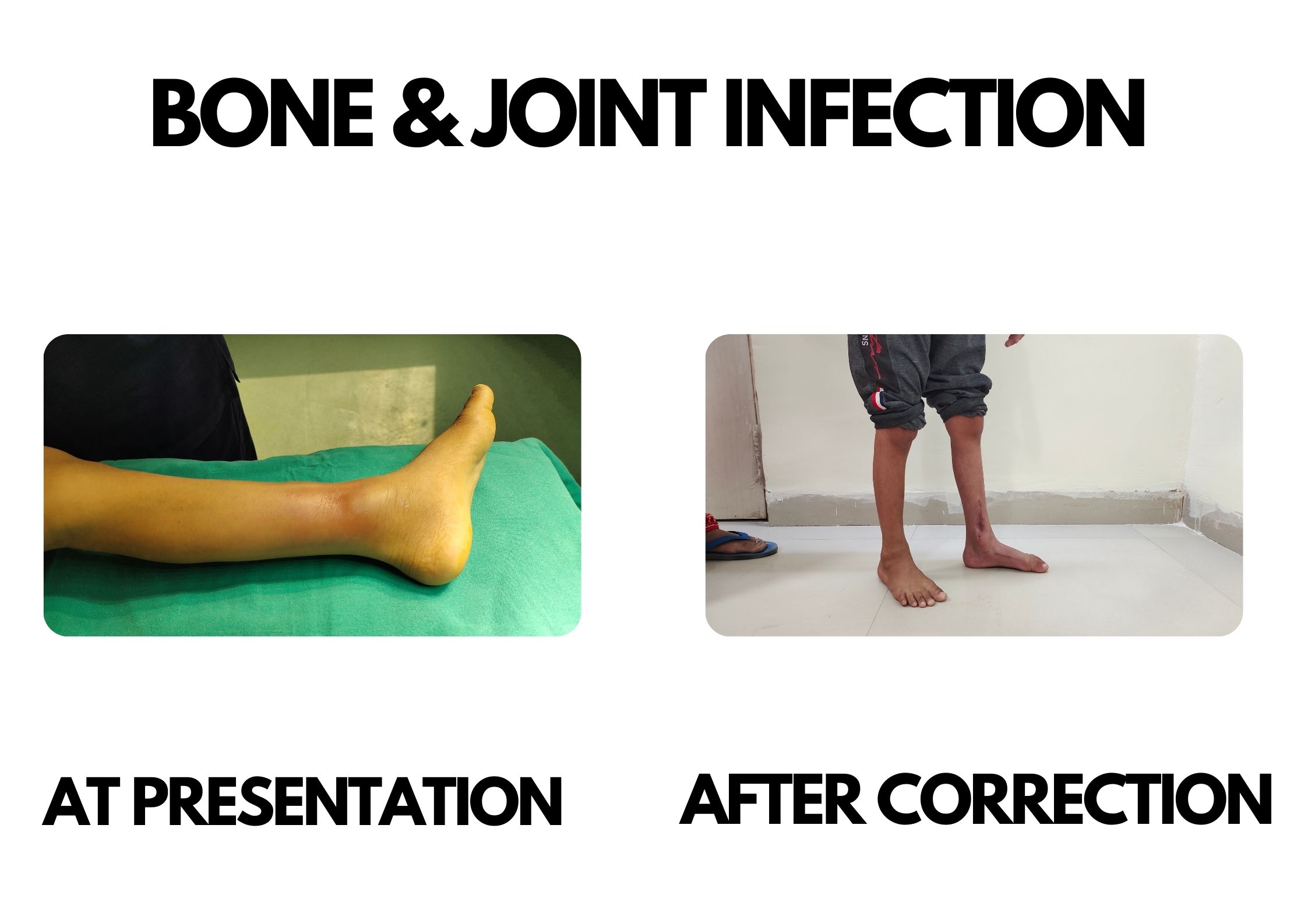 Bones and Joint Infection