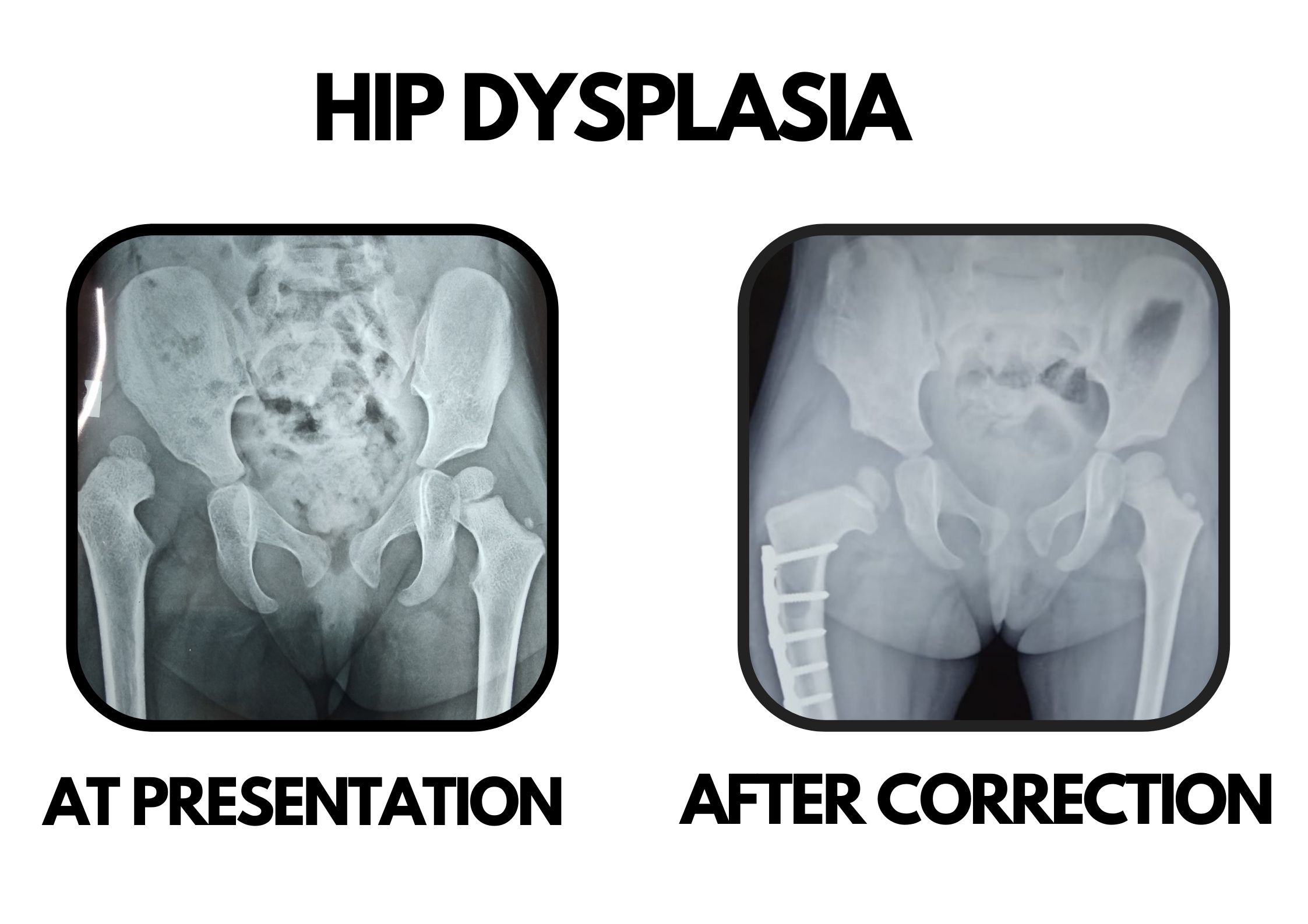 Hip dysplasia & preservation